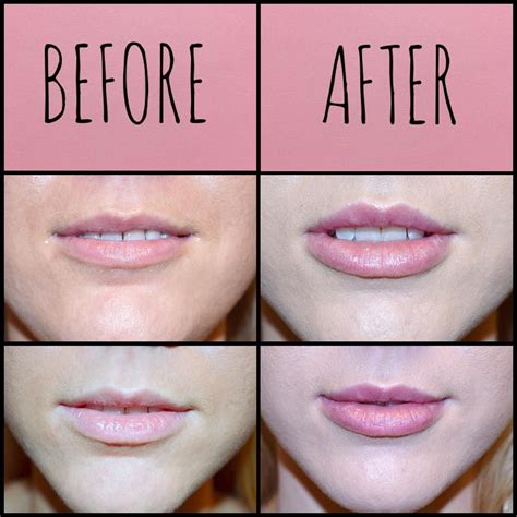 lip fillers near me ava|lip filler manufacturers.